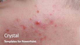  Presentation with acne - Presentation with hormone - human skin with acne closeup background and a coral colored foreground