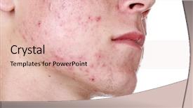  Presentation with acne - Amazing PPT theme having hormone - severe acne backdrop and a lemonade colored foreground