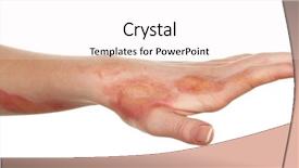  Presentation with injury - Cool new slides with horrible burns on female hand backdrop and a sky blue colored foreground