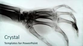  Presentation with medical hand - Cool new presentation design with human anatomy - detail of hand xray medical backdrop and a sky blue colored foreground