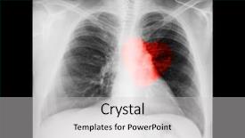  Presentation with chest - PPT theme having human heart - male chest x-ray on black background and a light gray colored foreground