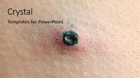  Presentation with chicken pox - Audience pleasing PPT layouts consisting of skin of human ill with chicken pox closeup backdrop and a soft green colored foreground