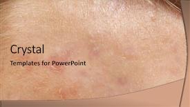  Presentation with acne - Amazing slide set having human skin with acne closeup backdrop and a coral colored foreground