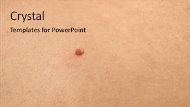  Presentation with skin - Slide set enhanced with melanoma - human skin with birthmark closeup background and a coral colored foreground