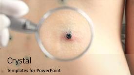  Presentation with chicken pox - Colorful slide set enhanced with human with chicken pox backdrop and a coral colored foreground