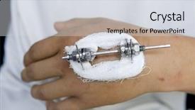  Presentation with orthopedic - Presentation theme consisting of ilizarov - fixation technique in orthopedic equipment background and a  colored foreground