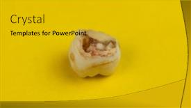  Presentation with decay - Amazing slide set having image-of-the-removed-tooth backdrop and a gold colored foreground