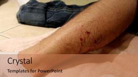  Presentation with wound - Slide set with infection education hospital - dog bite wound 3 background and a coral colored foreground