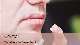  Presentation with herpes simplex virus - Presentation design featuring infection lips treatment by cream background and a soft green colored foreground