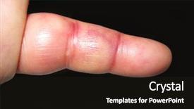  Presentation with injury - Slide deck with inflamation - finger injury swollen bruised background and a wine colored foreground
