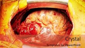  Presentation with interventional cardiology - Presentation design with interventional cardiology - human heart during cardiac surgery background and a red colored foreground