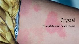  Presentation with robotic leg - Slides enhanced with itchy urticaria on woman leg background and a mint green colored foreground