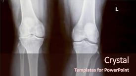  Presentation with knee replacement - Beautiful theme featuring knee xray backdrop and a wine colored foreground
