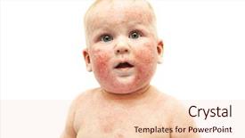  Presentation with dermatitis - Cool new slides with little baby with dermatitis backdrop and a lemonade colored foreground