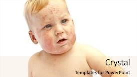  Presentation with dermatitis - Slides with little baby with dermatitis background and a lemonade colored foreground
