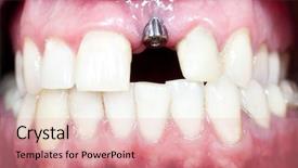  Presentation with dental implant - Amazing slide set having macro shot of dental implant backdrop and a coral colored foreground
