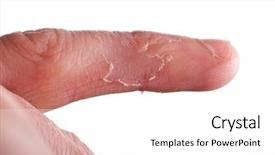  Presentation with skin infection - Slides with male finger with skin background and a pink colored foreground