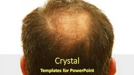  Presentation with symptoms - Beautiful presentation theme featuring male-head-with-hair-loss backdrop and a wine colored foreground