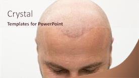  Presentation with implant - Slide deck featuring man-after-hair-implant-therapy background and a lemonade colored foreground