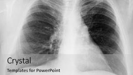  Presentation with chest x ray human - Slide deck consisting of lung radiation - male chest x-ray on black background and a light gray colored foreground