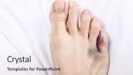  Presentation with foot pathology - Colorful slide set enhanced with medical prognosis - foot with broken toe backdrop and a lemonade colored foreground