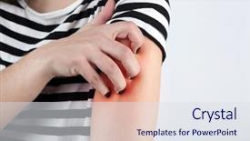  Presentation with allergies - Amazing presentation having mosquito - allergies concept woman scratching arm backdrop and a sky blue colored foreground