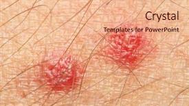  Presentation with symptoms - Colorful presentation theme enhanced with mosquito - bite mark sting or sore backdrop and a coral colored foreground