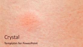  Presentation with mosquito - Colorful presentation design enhanced with mosquito pimple on woman skin backdrop and a lemonade colored foreground