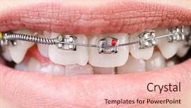  Presentation with medical concept - Audience pleasing presentation theme consisting of mouth with brackets braces backdrop and a lemonade colored foreground