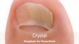  Presentation with fungi - Slides with nail suffering from fungus infection background and a coral colored foreground