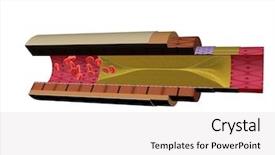  Presentation with nano - PPT layouts with nano medicine - artery blockage background and a white colored foreground