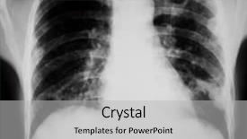  Presentation with chest - Slides enhanced with neck x rays - chest x-ray background and a light gray colored foreground