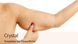  Presentation with obese - Slides featuring obesity surgery - picture of obese adult woman background and a lemonade colored foreground