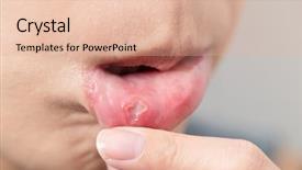  Presentation with foot mouth disease - Cool new presentation theme with oral disease - woman mouth suffer from aphtha backdrop and a lemonade colored foreground