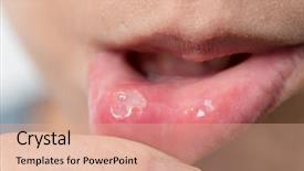  Presentation with disease - Slides enhanced with oral disease - woman suffer from aphtha background and a coral colored foreground