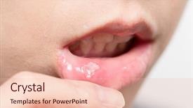  Presentation with foot mouth disease - Presentation design having oral pain - get hurt on mouth background and a lemonade colored foreground