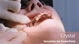  Presentation with bone - Presentation theme featuring oral-surgeon-shows-installed-dental background and a coral colored foreground