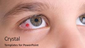  Presentation with child eye - Beautiful slides featuring photo of an infected eye backdrop and a coral colored foreground