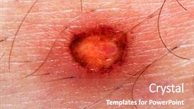  Presentation with burn - Beautiful slides featuring physical injury blood wound skin backdrop and a coral colored foreground