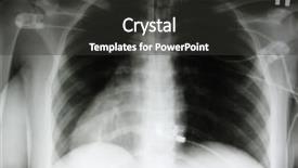  Presentation with xray - Cool new presentation design with physical science - xray of a chest ribs backdrop and a dark gray colored foreground