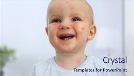  Presentation with chicken pox - Colorful PPT theme enhanced with childhood immunization - little boy with red pimples backdrop and a sky blue colored foreground