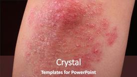  Presentation with psoriasis - Cool new slides with plaque - psoriasis on an elbow showing backdrop and a coral colored foreground