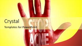 Presentation with acne - Audience pleasing slide set consisting of psoriasis - stop acne written on hand backdrop and a white colored foreground