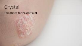  Presentation with psoriasis - Audience pleasing PPT theme consisting of psoriasis-on-elbow-on-white backdrop and a soft green colored foreground