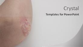  Presentation with psoriasis - PPT theme with psoriasis-on-elbow-on-white background and a light gray colored foreground