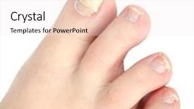  Presentation with nail - Presentation theme featuring deformity foot - reconstruction nail background and a sky blue colored foreground