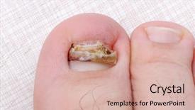  Presentation with broken leg - Slides with ringworm infection - broken ill nail on leg background and a lemonade colored foreground