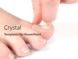 Ringworm Infection Male Foot And Toes PPT template 51 | CrystalGraphics