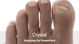  Presentation with fungus - Beautiful PPT layouts featuring ringworm infection - toenail fungus isolated backdrop and a tawny brown colored foreground