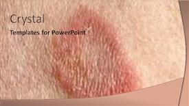  Presentation with fungal infection - Colorful PPT theme enhanced with ringworm-infection-on-the-arm backdrop and a lemonade colored foreground